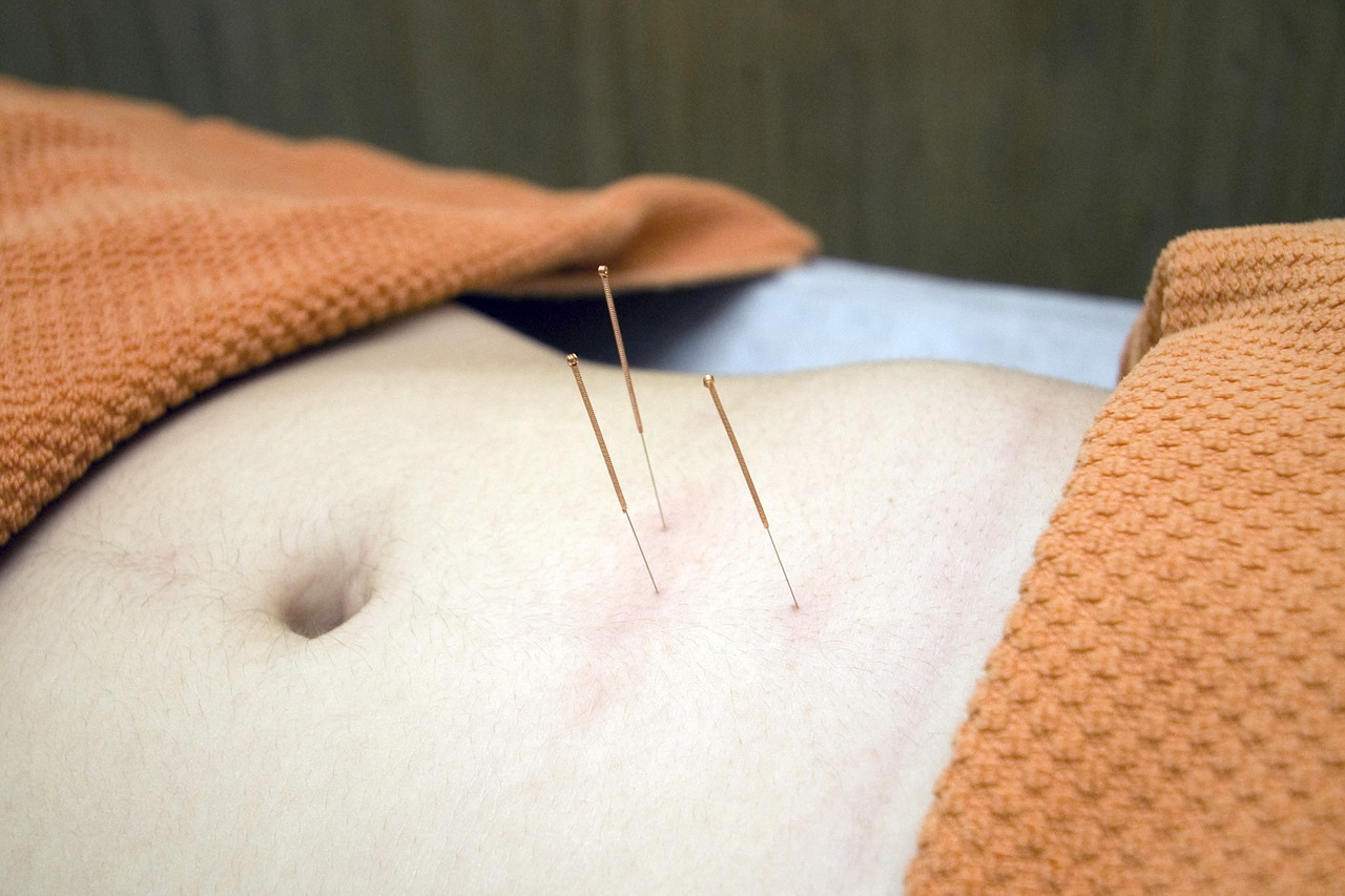 acupuncture-4175624_1280