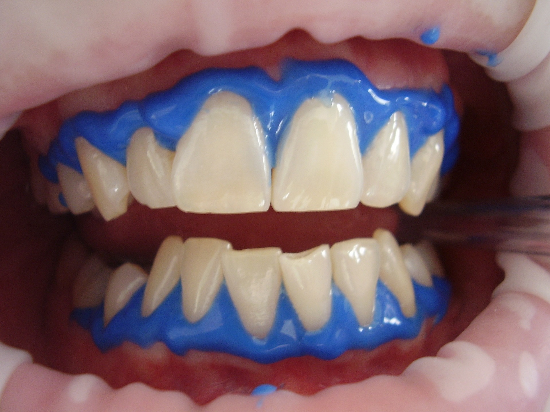 laser-teeth-whitening-716468_1920