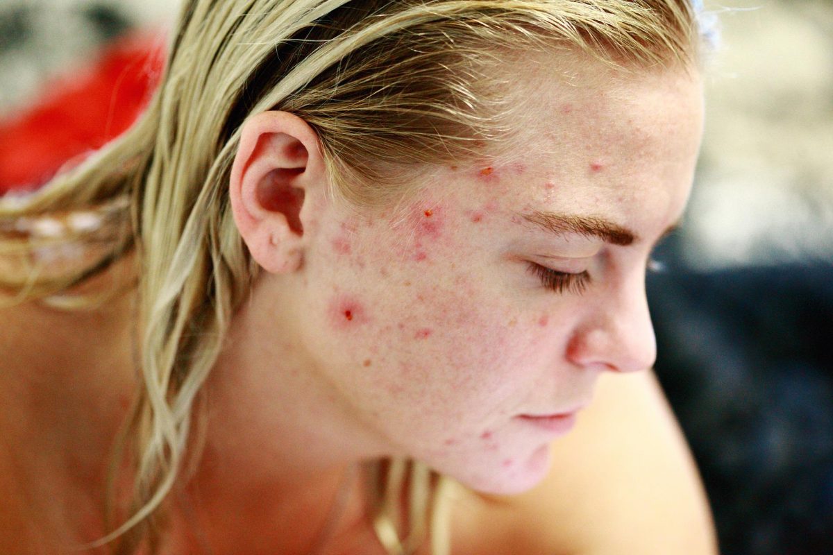 Don’t Panic! Here’s How To Get Rid Of A Pimple Fast