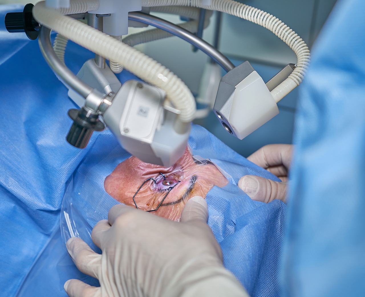 eye-laser-surgery-ga2ae19b53_1280